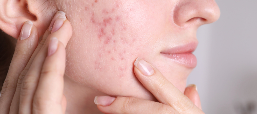 Acne premestruale, come riconoscerla e trattarla Acne premestruale, come riconoscerla e trattarla