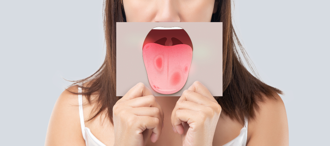 Stomatite sulla lingua: di cosa si tratta e come curarla Stomatite sulla lingua: di cosa si tratta e come curarla